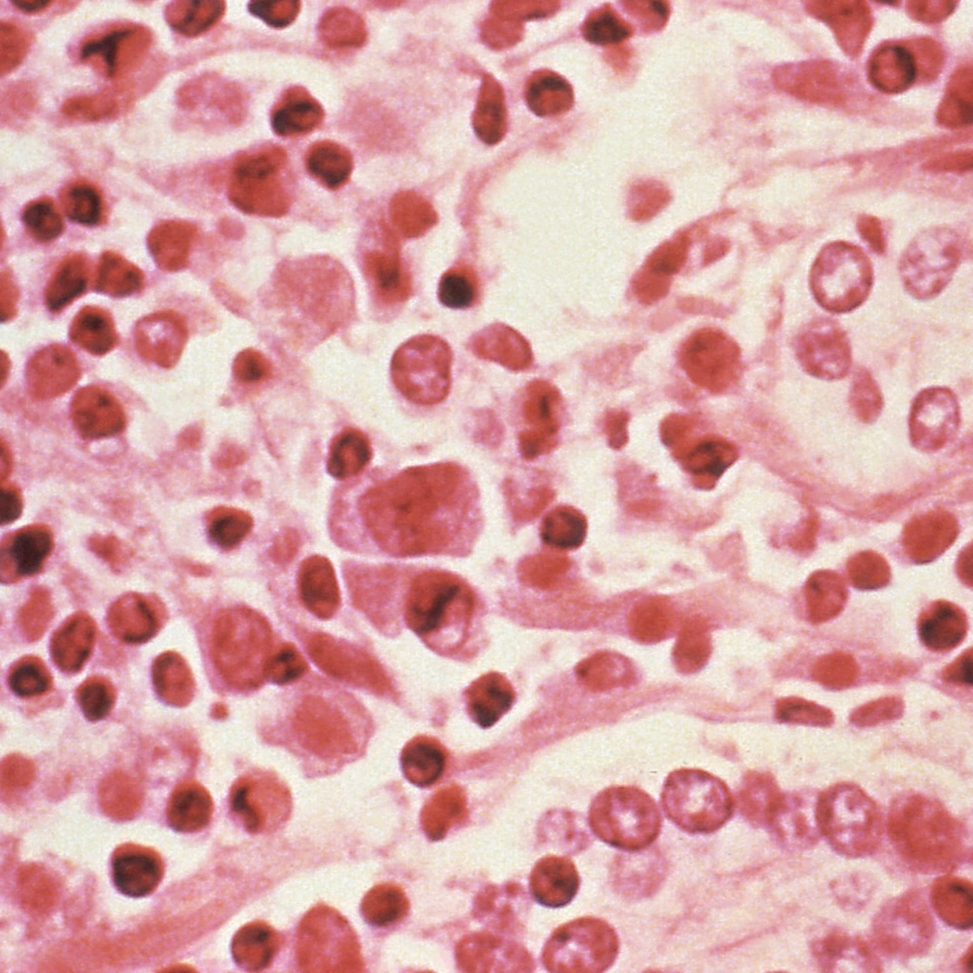 WHO: Hantavirus may have spread between humans — Global News Podcast cover