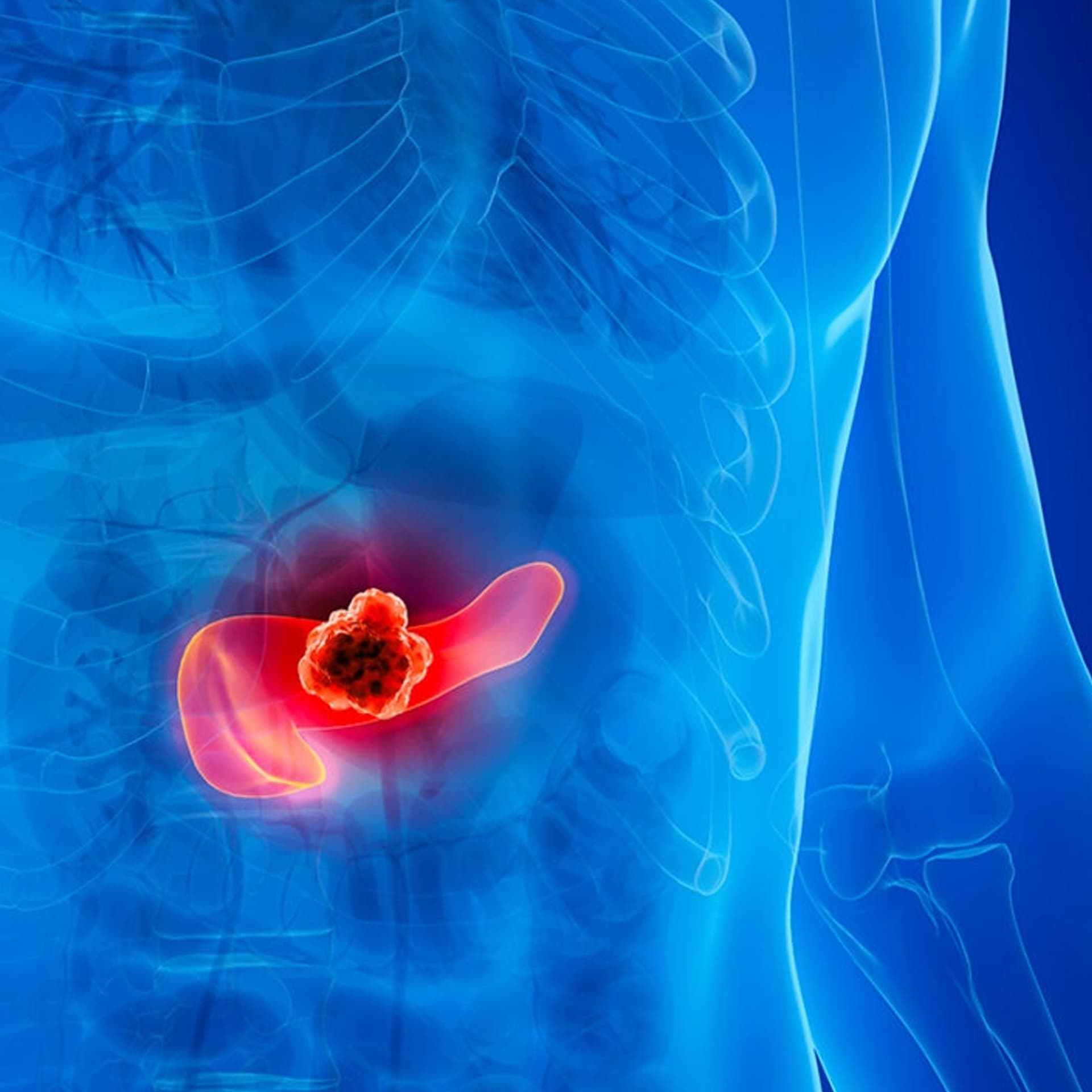 Insulin Resistance is Silent Driver of Pancreatic Cancer - The Report cover
