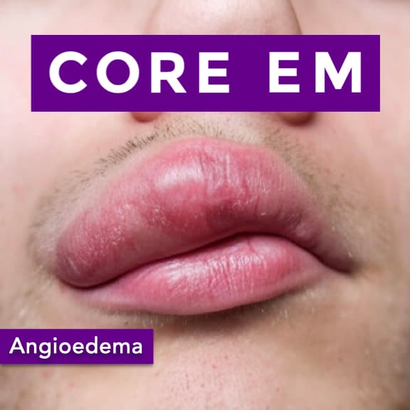 Episode 212: Angioedema - Core EM - Emergency Medicine Podcast cover