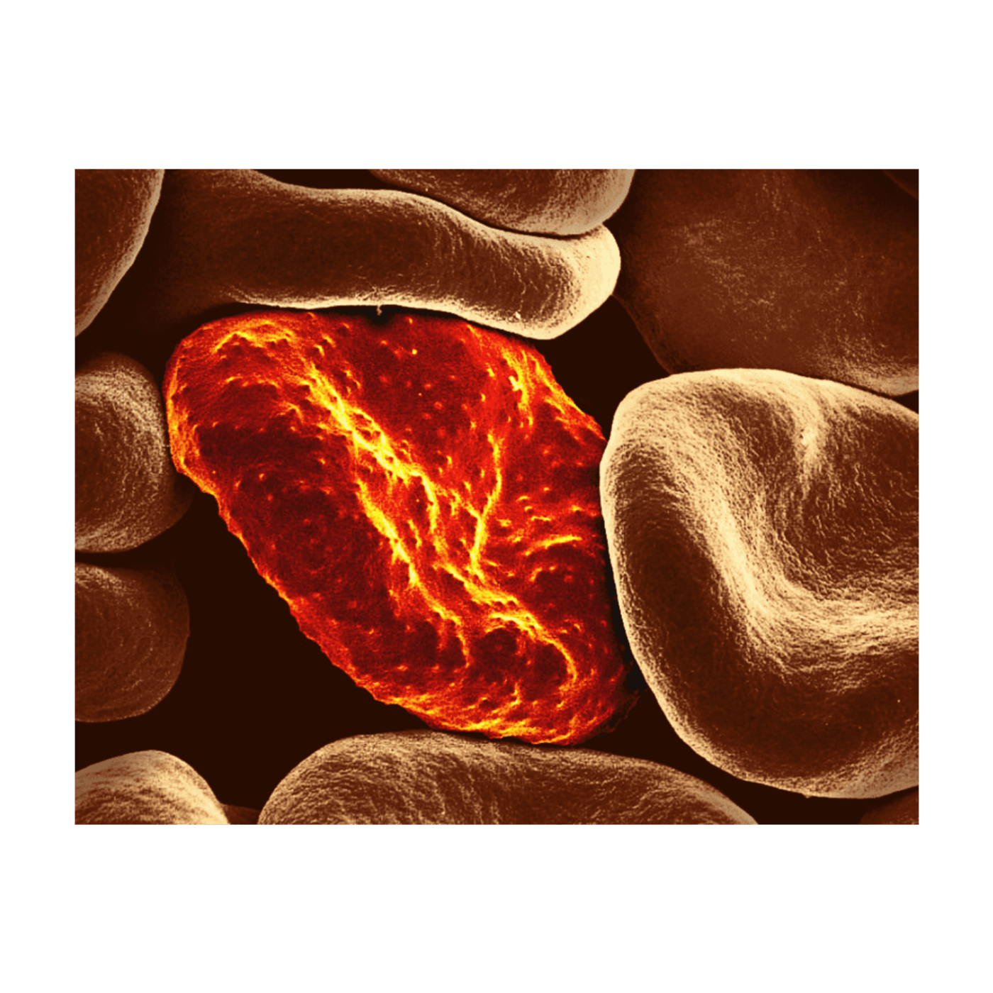 ID4U Episode 5 Severe Malaria - ID4U - Infectious Disease Podcasts for Users of the CMES program cover