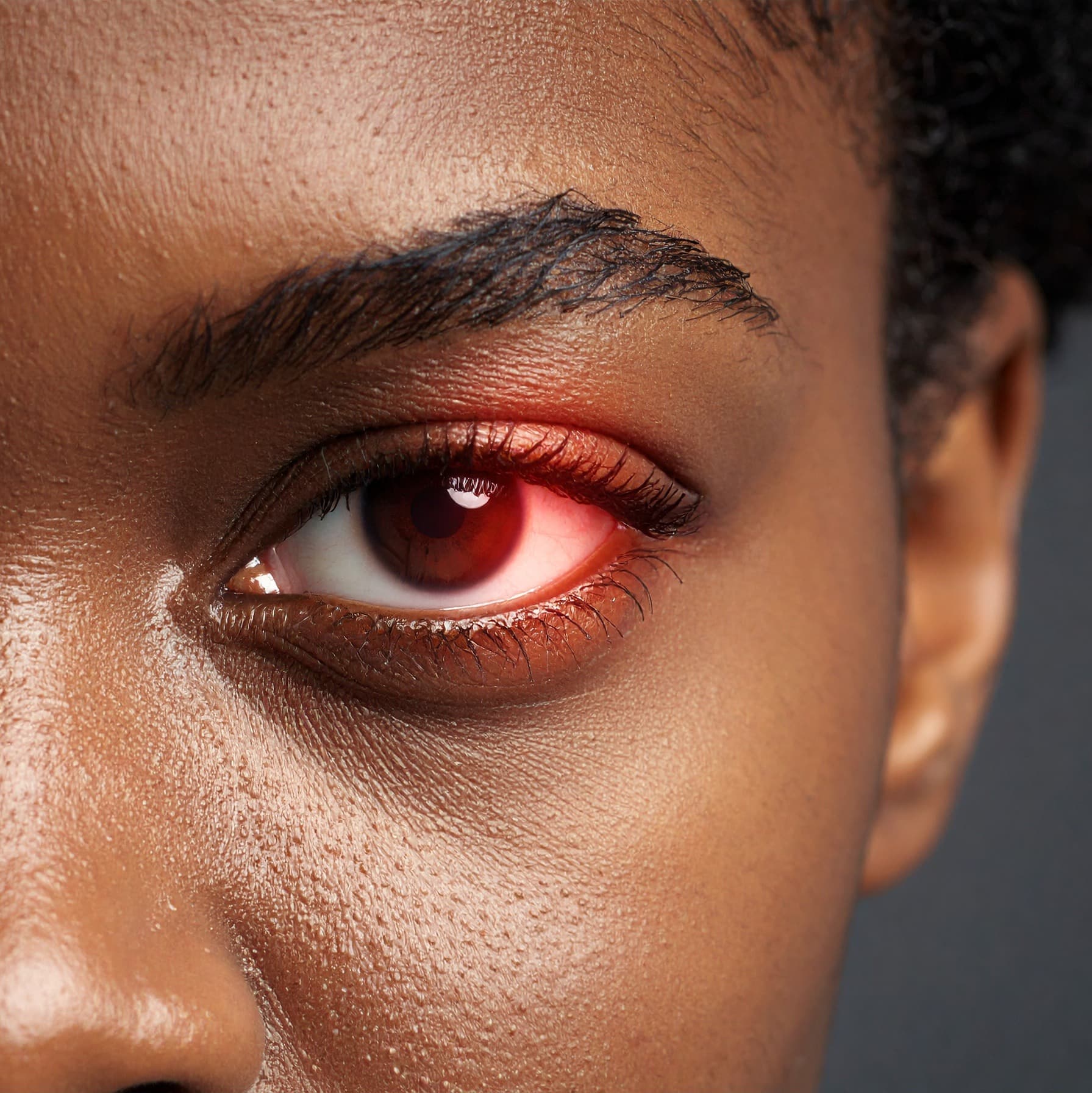 ID4U Episode 15 Trachoma - ID4U - Infectious Disease Podcasts for Users of the CMES program cover