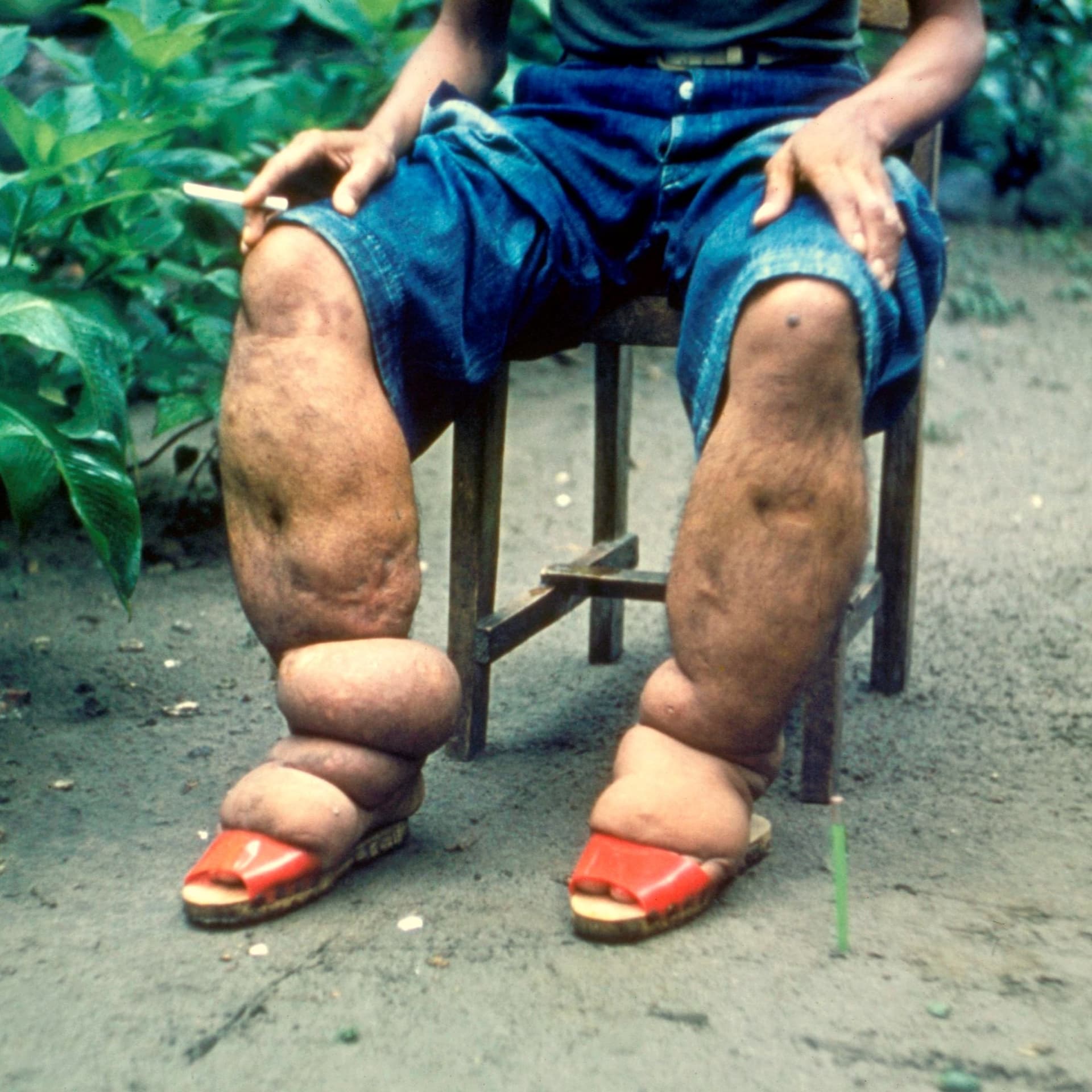ID4U Episode 17 Lymphatic Filariasis - ID4U - Infectious Disease Podcasts for Users of the CMES program cover