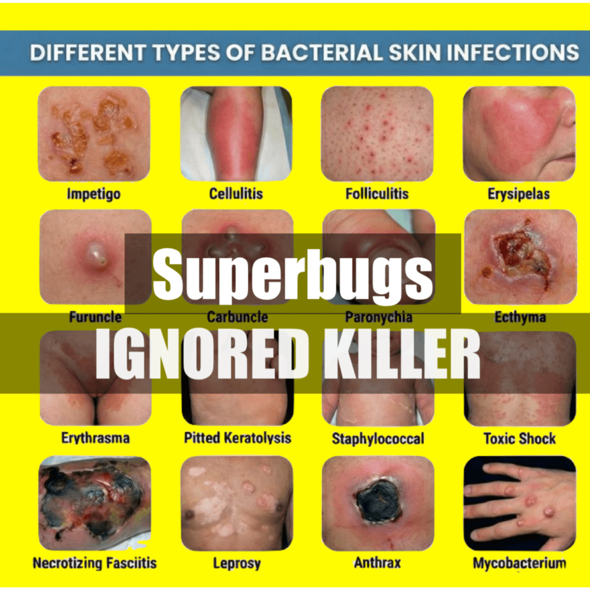 How Superbugs Are Out smarting Modern Medicine and Why Are the Public Health Experts, and WHO talking about Virus as the Killer Bug that Treated our Existance? - Fear Is the First Infection that Spread and Kill, and Not the Virus during Post-Antibiotic Era. cover