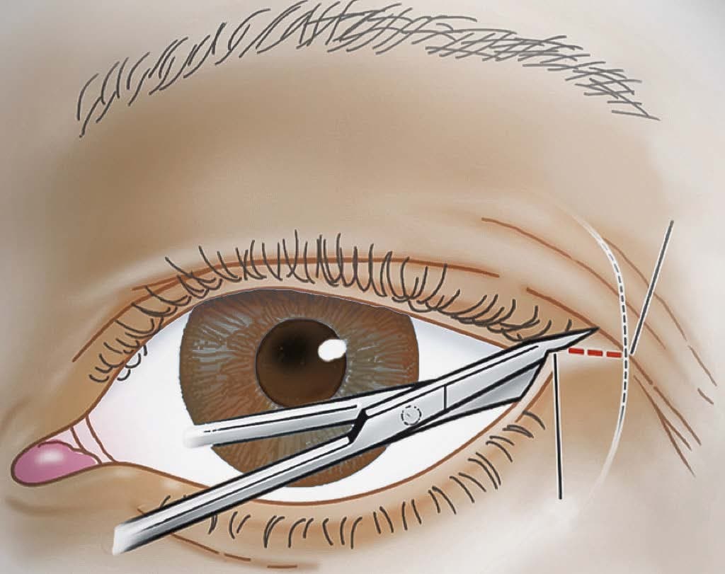 423. Ocular Trauma 1: Lid Lacerations and Orbital Compartment Syndrome - Surgery 101 cover