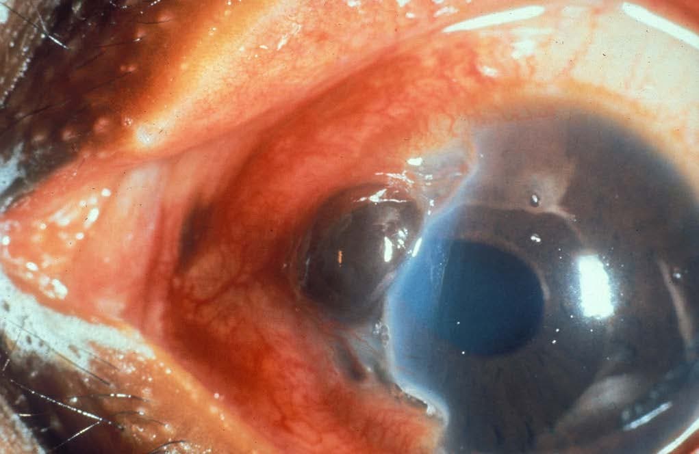 424. Ocular Trauma 2: Intraocular Foreign Bodies and Globe Rupture - Surgery 101 cover
