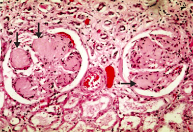 Diabetic Nephropathy - The Rx Bricks Podcast cover