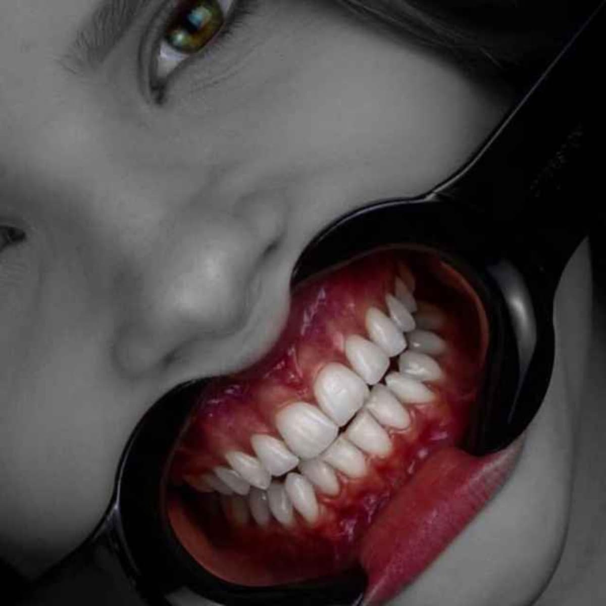 139- Prosthetic Materials in Implant Crown :part1 - Dentcast cover